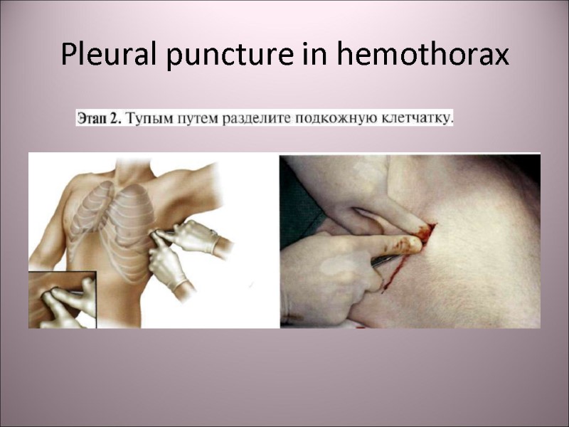 Pleural puncture in hemothorax